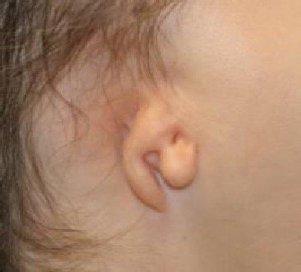 anotia-chirurgia-ricostruttiva-padiglione-auricolare (1) Microtia - Anotia - Casa di Cura Piacenza