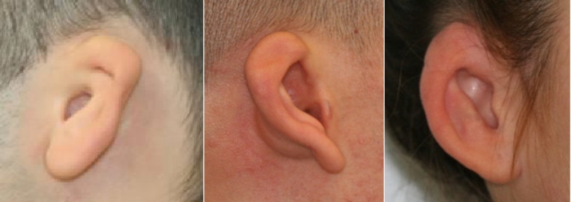 microtia-secondo-grado-chirurgia-ricostruttiva-padiglione-auricolare (1) Microtia di grado II - Casa di Cura Piacenza