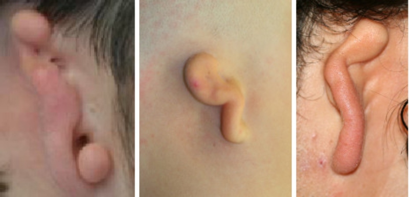 microtia-terzo-grado-chirurgia-ricostruttiva-padiglione-auricolare (1) Microtia di grado III - Casa di Cura Piacenza