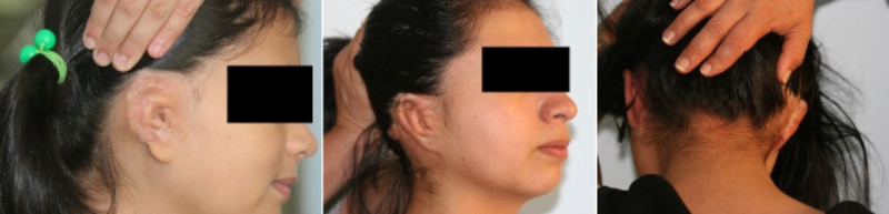 Ricostruzione del padiglione auricolare Accesso cutaneo - Microtia - Casa di Cura Piacenza